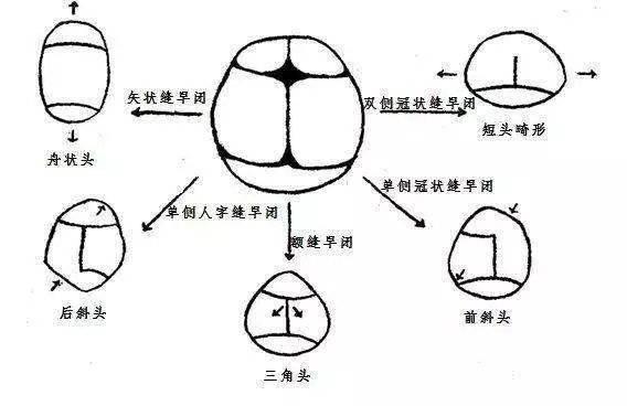 颅腔|2个月大宝宝竟长“方头”！这种病影响孩子头部发育