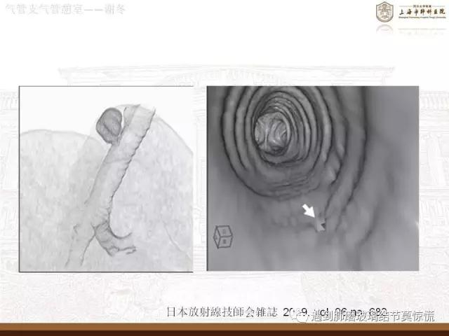 遇到气管、支气管憩室莫惊慌