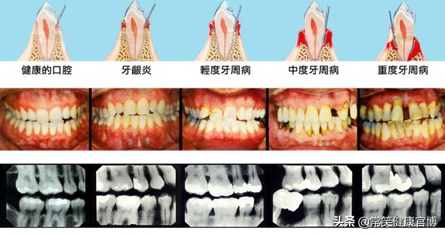 这四大口腔健康问题，正在加速你的衰老进程