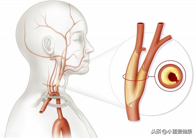 男子因按摩导致突发眩晕，医生说竟然是得了脑梗塞，病情很严重