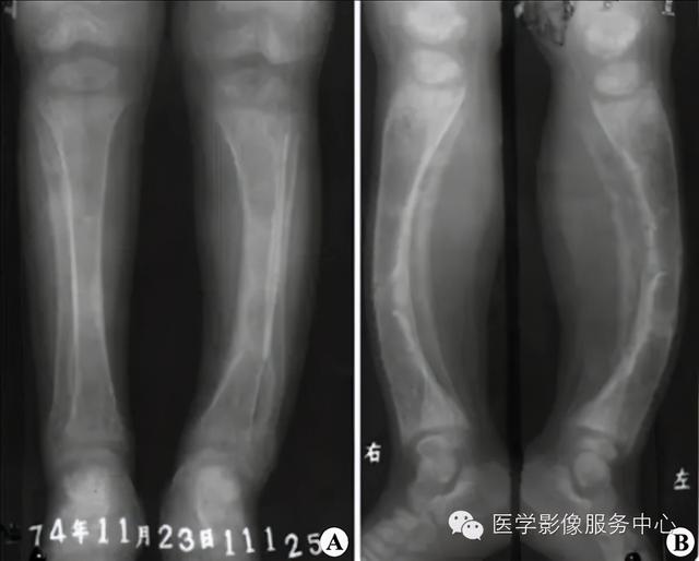 收藏 |：79种典型骨肌影像病例，助你诊断无忧