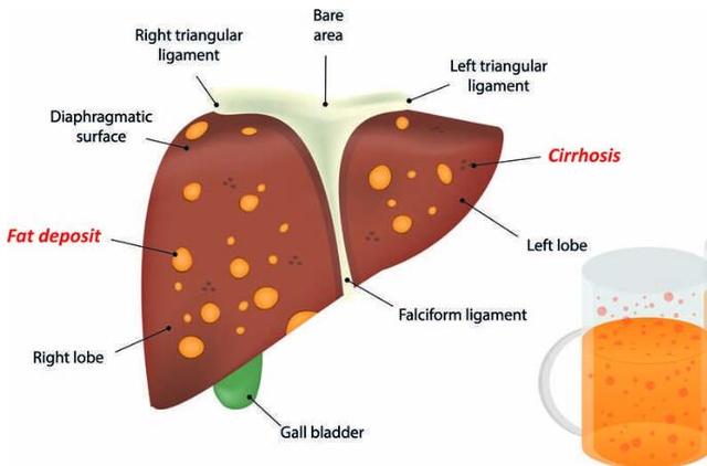 酒量突然发生变化，警惕肝脏受损！这3个异常，或是肝癌找上门了