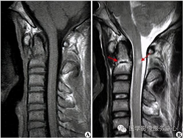 77种骨肌影像病例，助你诊断无忧