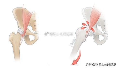 疼痛|「译文分享」弹响髋综合征的成因分析与康复方法
