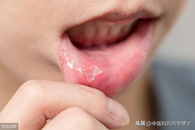 你的育儿经▲口腔溃疡就补VC？一直这么做，竟然又错了！专家：对因用药好得快