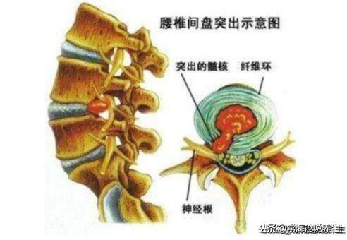 纤维环|还在被腰椎间盘疾病困扰？3种不同腰椎问题，别再傻傻分不清