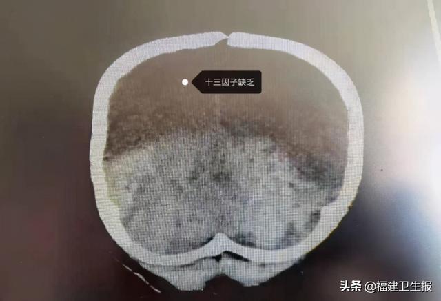出血|厦门1岁宝宝在家摔倒，颅内巨大血肿全然不知！孩子磕碰摔伤，这些紧急处理千万别做错