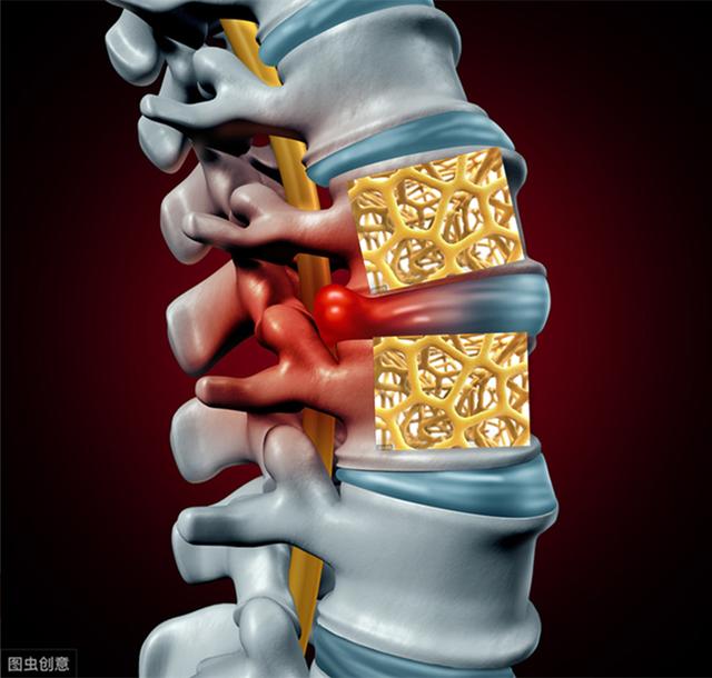 椎间盘|腰椎间盘突出当成骨质疏松治疗，居然治好了，真相是怎样呢？