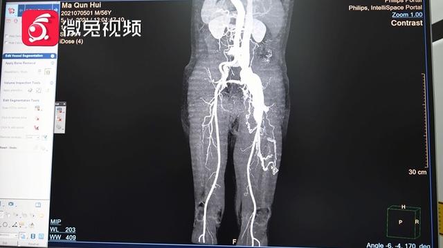 师傅|惊！贵阳一男子腿部剧痛、皮肤发黑！竟是铁片藏里面20多年