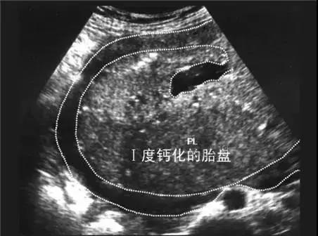 超级宝妈@补钙会使胎盘钙化？医生：两者没有任何关系