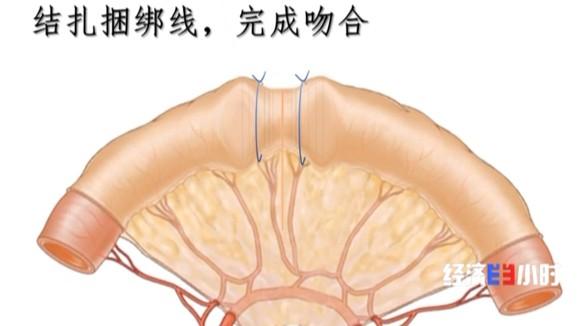 临床|国际首创！青光眼患者有了新希望！超千人已受益