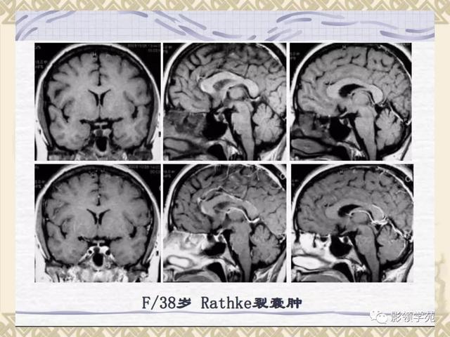 垂体病变的MRI诊断