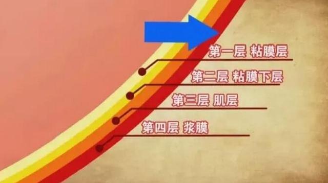 胃溃疡|为什么会有人得胃溃疡？得了胃溃疡该怎么吃？