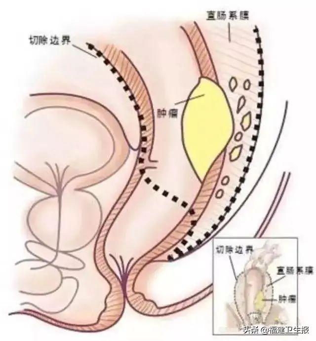 肿瘤|厦门女子肿瘤长在了“菊花”边上，机器人精准“保菊”不留切口