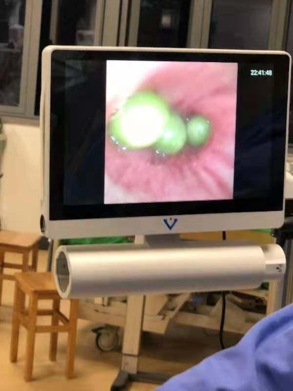 青豆|十几颗豆子差点要了老人的命！医生：发生误吸应该这样做