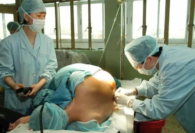 你的育儿经:产妇无节制地吃东西,麻醉医师如何应对?