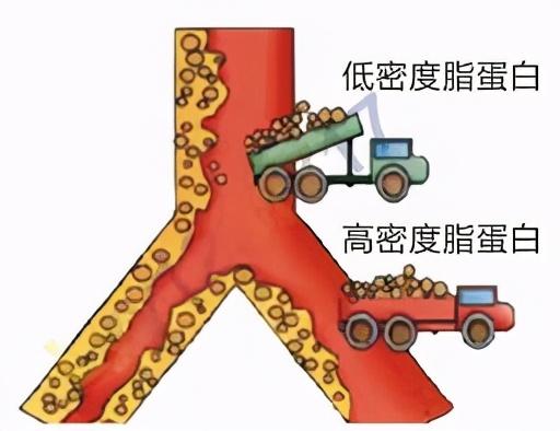 心脑血管病的祸根“低密度脂蛋白胆固醇”，做到这几点就能控制