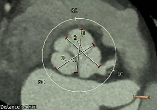 罕见！76岁老人心脏主动脉瓣多一个瓣叶，伴严重冠心病等，多学科新技术解难题