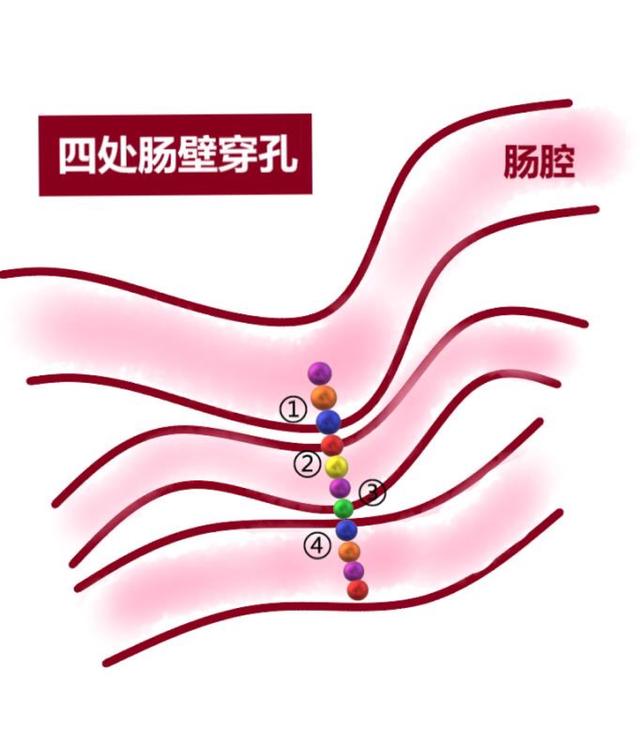 「超级宝妈」玩具选择应注意:2岁男孩误食11颗磁力珠造成肠穿孔