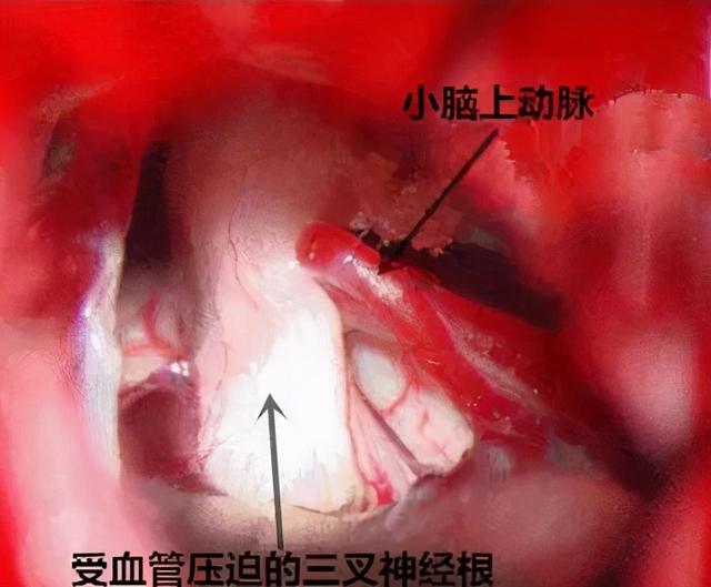 浅谈三叉神经痛的基本认识