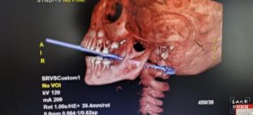 竹签|玉溪5岁男童吃搅搅糖不慎摔倒，竹签插喉7厘米…...