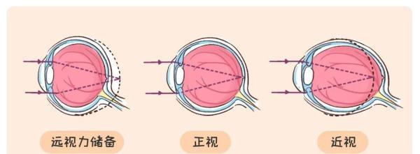 视力|不看电视不玩iPad，娃还是近视了？假期提醒：儿童眼健康常见9大误区请注意