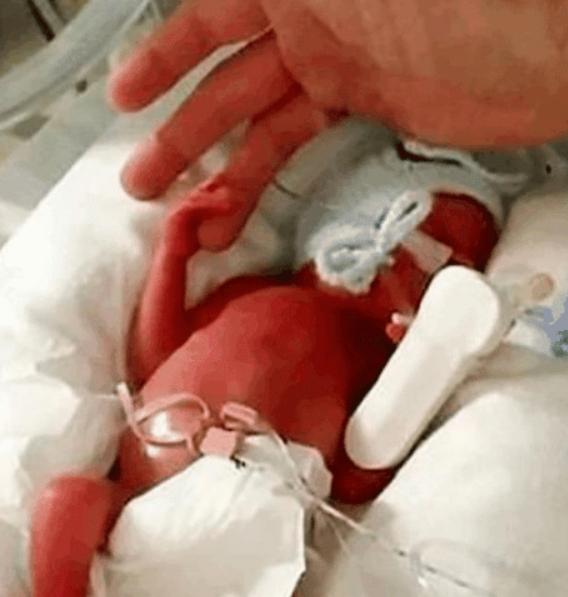 我们的那些年|产妇生下“迷你宝宝”，新生儿仅巴掌大小，医生：能活下来是奇迹