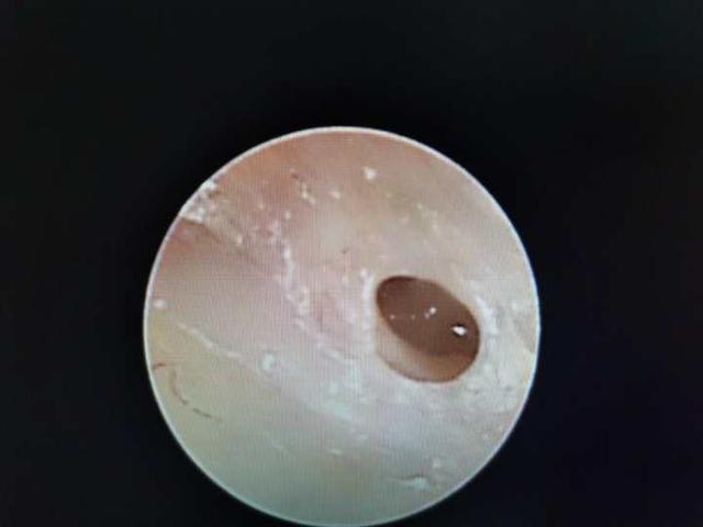 中耳|30年前她经历了一次意外，如今靠着自体人工听骨重建，重回有声的世界