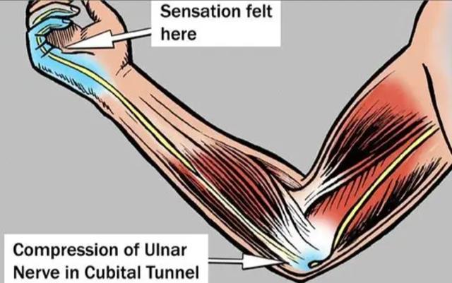 趴在床上玩手机，为什么感觉手麻了？医生：尺神经被压到了