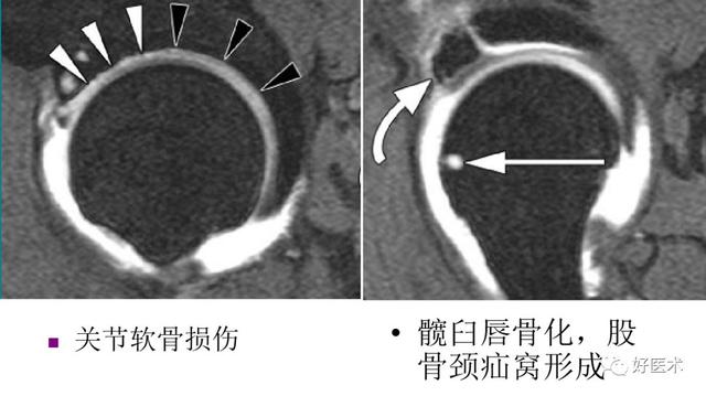 一文读懂髋关节撞击综合征