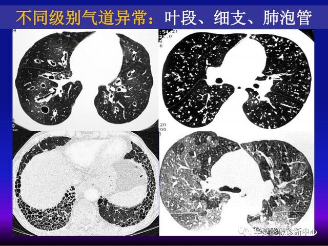 肺间质性疾病的解剖、病理、影像分析