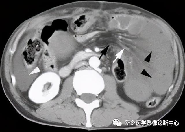 夜间值班腹部疼痛原因影像表现，值得收藏