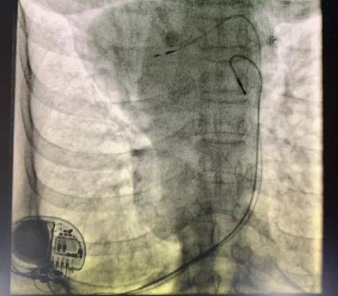 重庆首例3.0T磁共振兼容超大电池容量起搏器成功植入