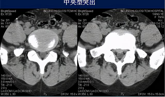 腰椎间盘CT诊断：椎间盘膨出、突出、椎管狭窄及退行性病变