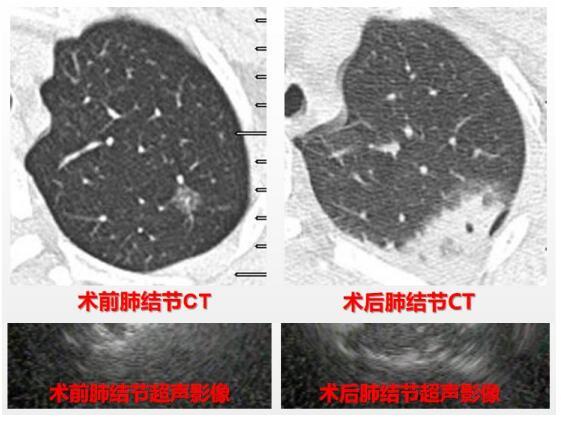 结节|肺小结节微创手术治疗新突破 鼓医完成首例电磁导航引导肺结节微波消融术