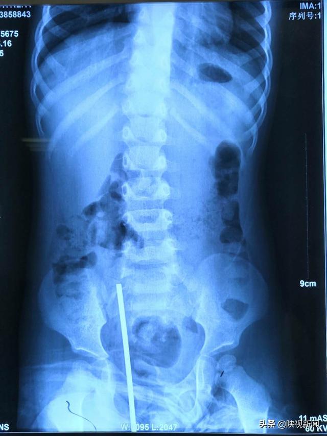 你的育儿经▲12厘米玩具车轴刺入男童体内，幸好家长做了这件事