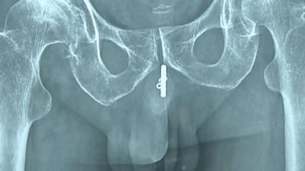大爷|用金属管能助排尿？大爷听信偏方塞入下体15公分 结果断了……