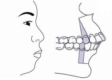 龅牙也分好几种，有的单纯靠矫正无法调整，你知道你属于哪种吗？
