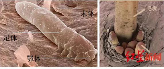 螨虫|螨虫在20岁女大学生眼里“安家”，原因竟是种睫毛……
