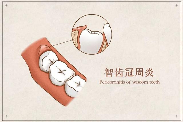 【科普】长了智齿该不该拔？这6类人别随意拔，严重时可危及生命.....