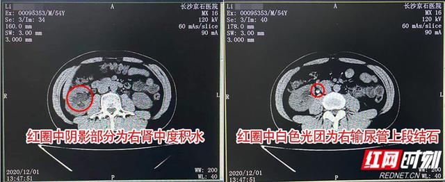 “麻将狂人”突发腰痛误认为久坐所致 检查发现结石危机