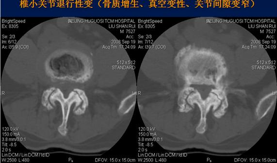 腰椎间盘CT诊断：椎间盘膨出、突出、椎管狭窄及退行性病变