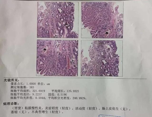 查出来胃黏膜“肠化、不典型增生”，就只能“等它癌变”吗？