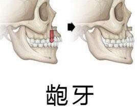 龅牙也分好几种，有的单纯靠矫正无法调整，你知道你属于哪种吗？