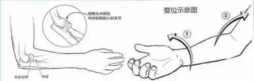 超级宝妈|小孩手肘痛不敢动，原来是脱位了