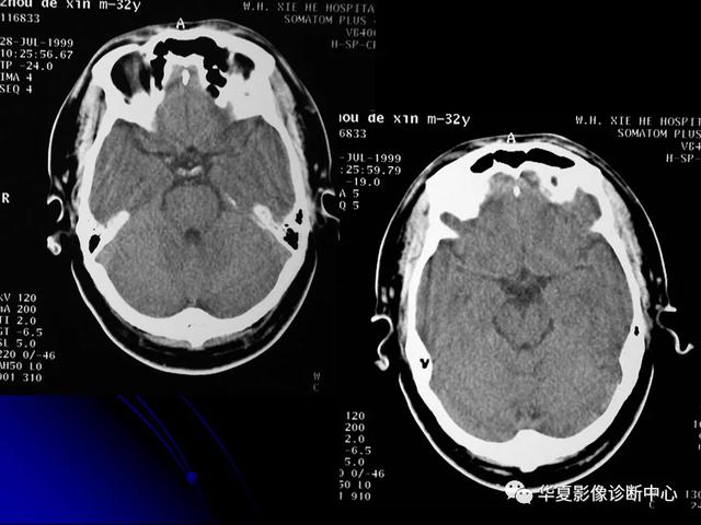 「影像复习」脑干区常见病变影像表现