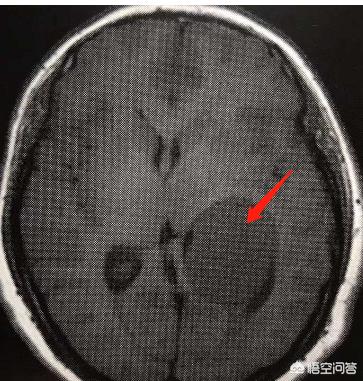 病理检查|一文告诉大家：手术切肿瘤，医生是怎么判断肿瘤切干净没有的？