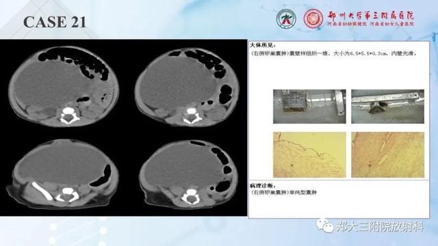 儿童腹部囊性病变诊断思路分析