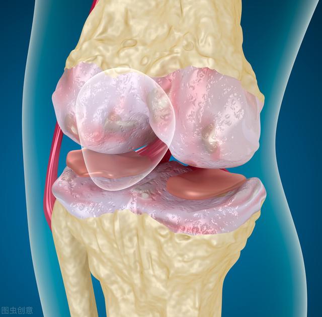 只有老年人才会得关节炎？你错了，这几类人也很受“偏爱”