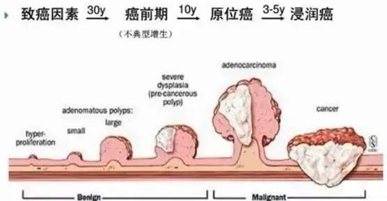 直肠癌|辟谣：痔疮会癌变？医生告诉你：不会的，但容易把直肠癌当成痔疮